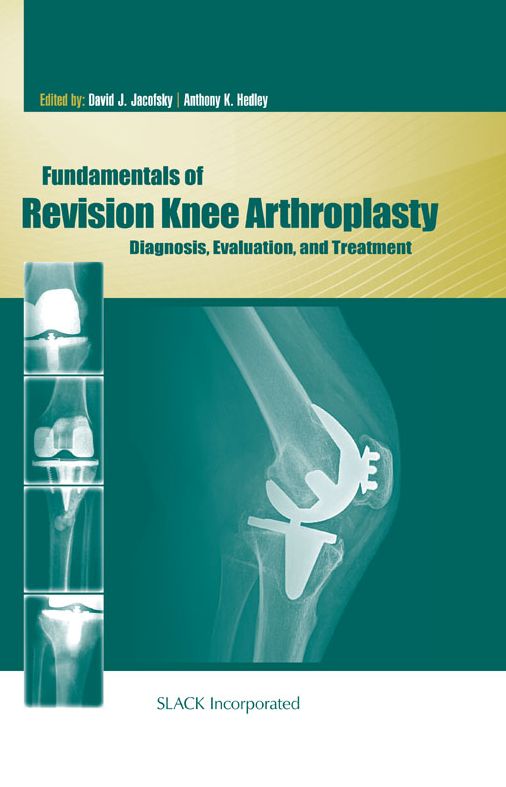 Fundamentals of Revision Knee Arthroplasty: Diagnosis, Evaluation, and Treatment
