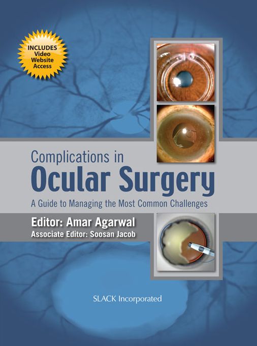 Complications in Ocular Surgery: A Guide to Managing the Most Common Challenges
