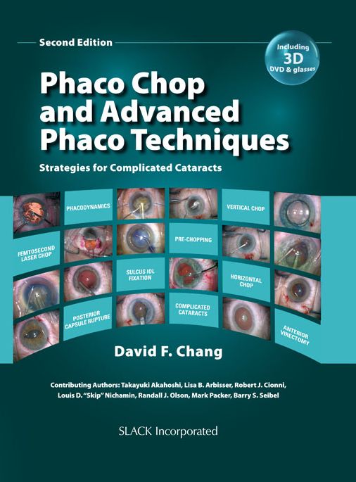 Phaco Chop and Advanced Phaco Techniques: Strategies for Complicated Cataracts, Second Edition