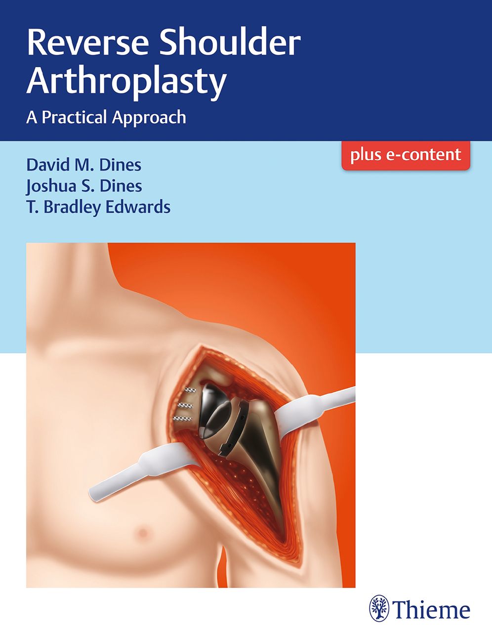 Reverse Shoulder Arthroplasty: A Practical Approach