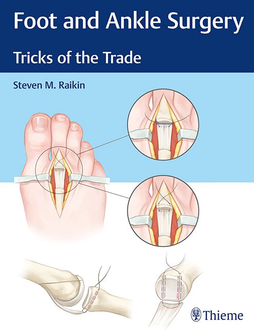 Foot and Ankle Surgery: Tricks of the Trade