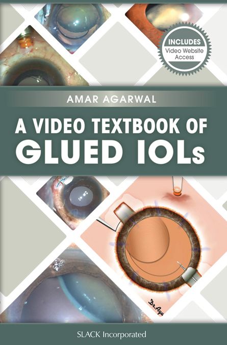 A Video Textbook of Glued IOLs