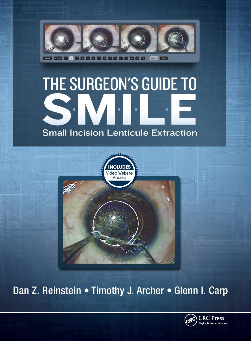 The Surgeon's Guide to Smile: Small Incision Lenticule Extraction
