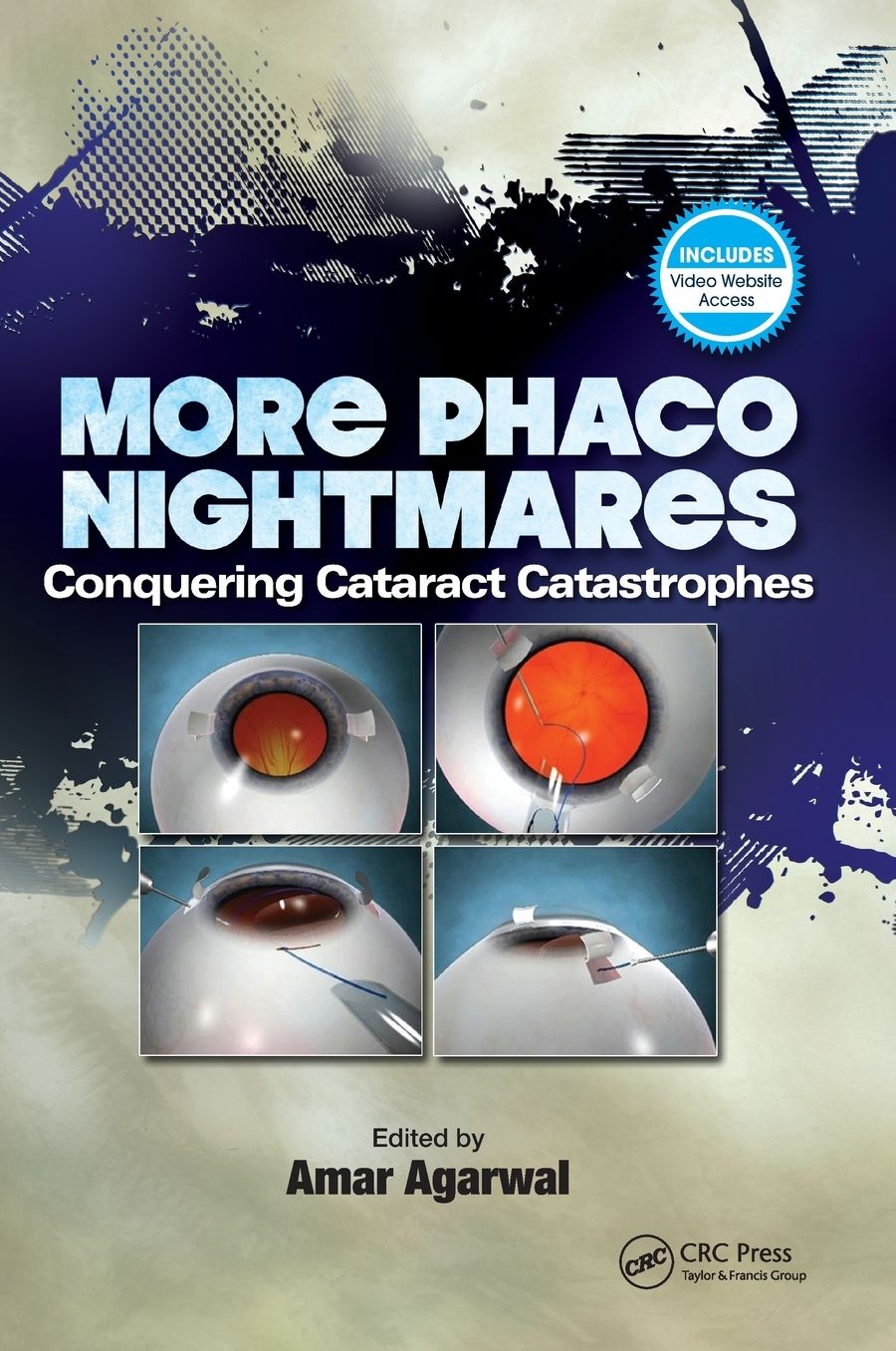 More Phaco Nightmares: Conquering Cataract Catastrophes