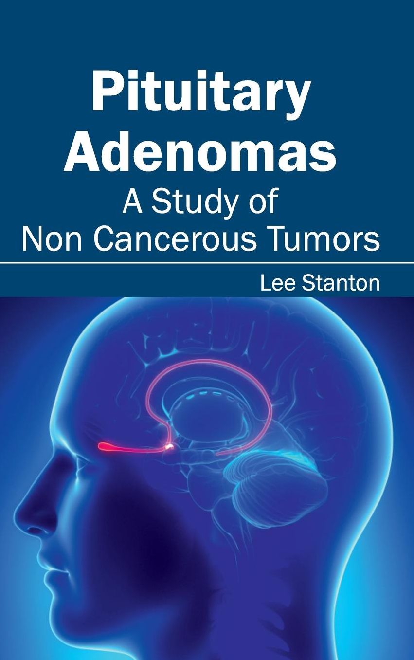 Pituitary Adenomas: A Study of Non Cancerous Tumors