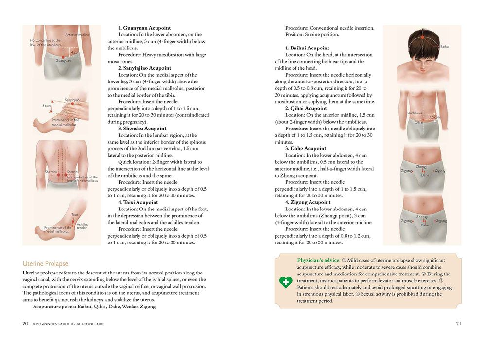 A Beginner's Guide to Acupuncture: Treating Common Ailments through Traditional Chinese Medicine