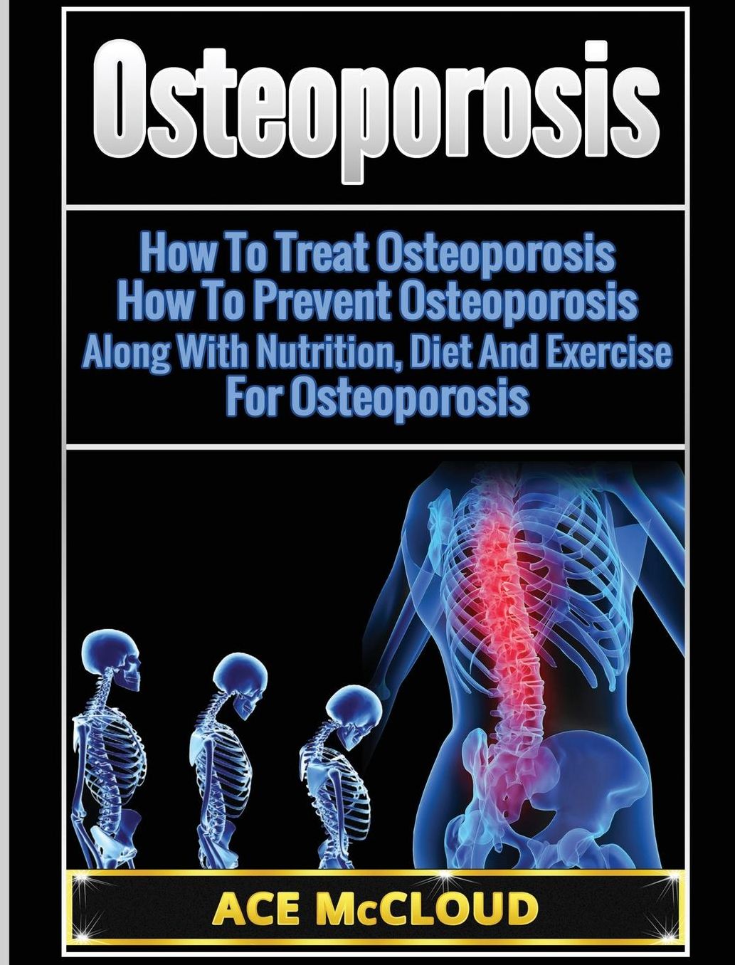 Osteoporosis: How To Treat Osteoporosis: How To Prevent Osteoporosis: Along With Nutrition, Diet And Exercise For Osteoporosis