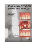 Bone Augmentation in Oral Implantology