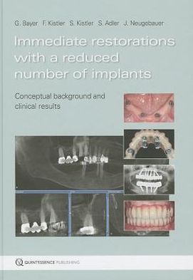 Immediate Restorations with a Reduced Number of Implants: Conceptual Background and Clinical Results