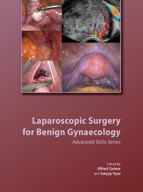 Laparoscopic Surgery for Benign Gynaecology with DVDs