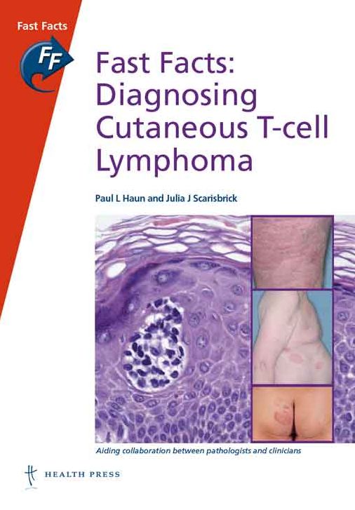 Fast Facts: Diagnosing Cutaneous T-cell Lymphoma