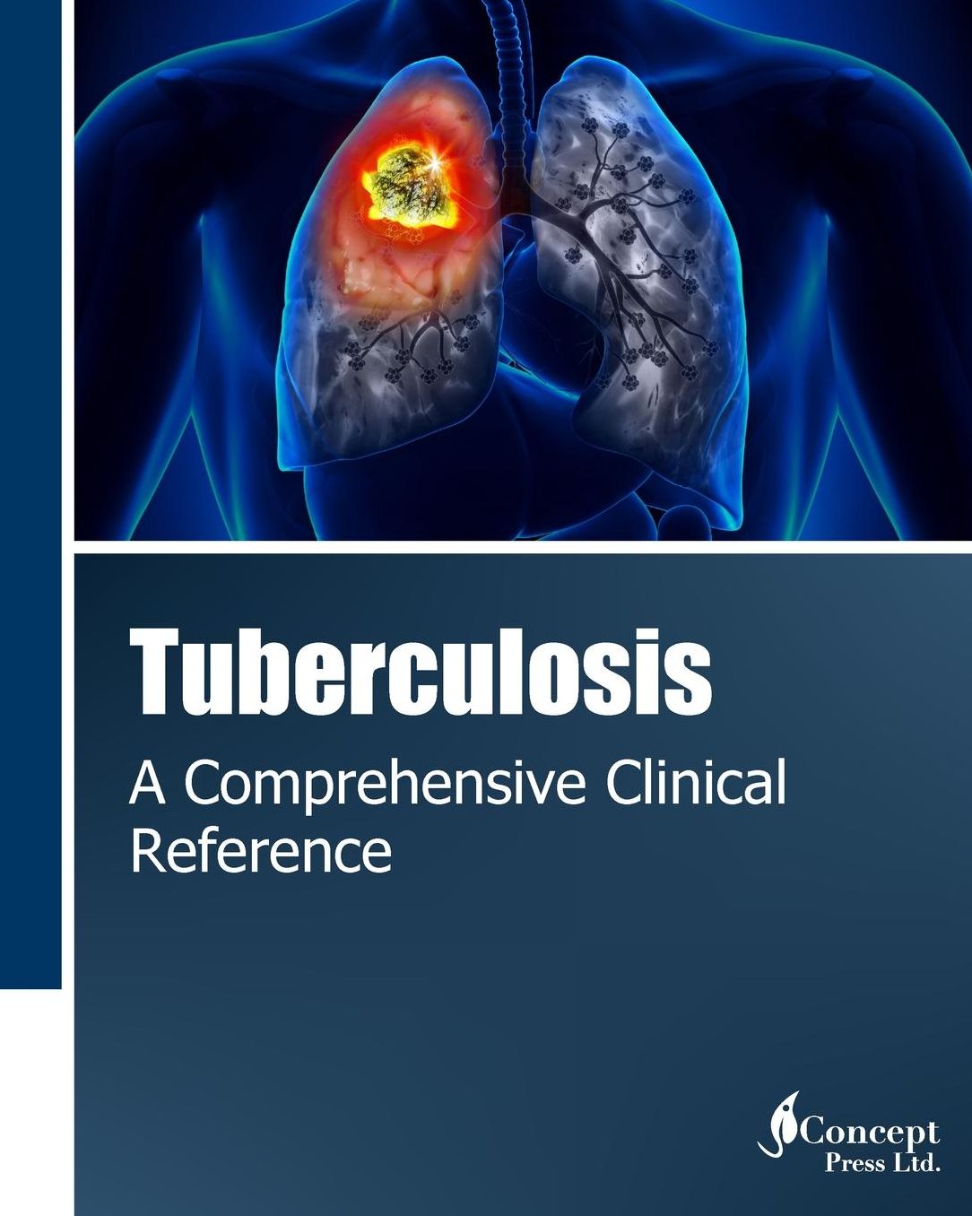 Tuberculosis: A Comprehensive Clinical Reference