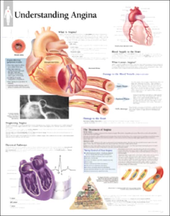 Understanding Angina Anatomical Wall Chart
