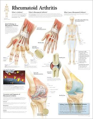 Rheumatoid Arthritis