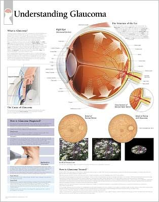 Understanding Glaucoma chart