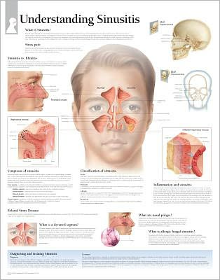 Understanding Sinusitis chart
