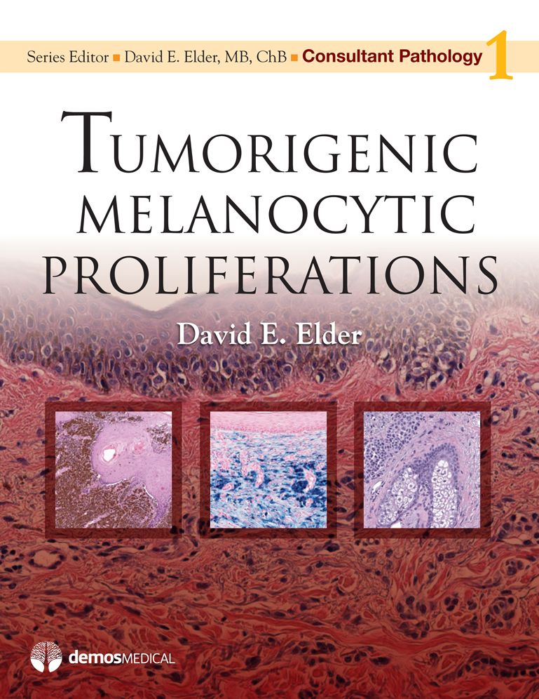Tumorigenic Melanocytic Proliferations
