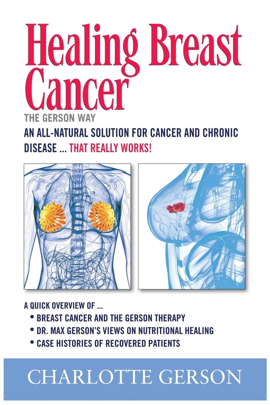 Healing Breast Cancer the Gerson Way