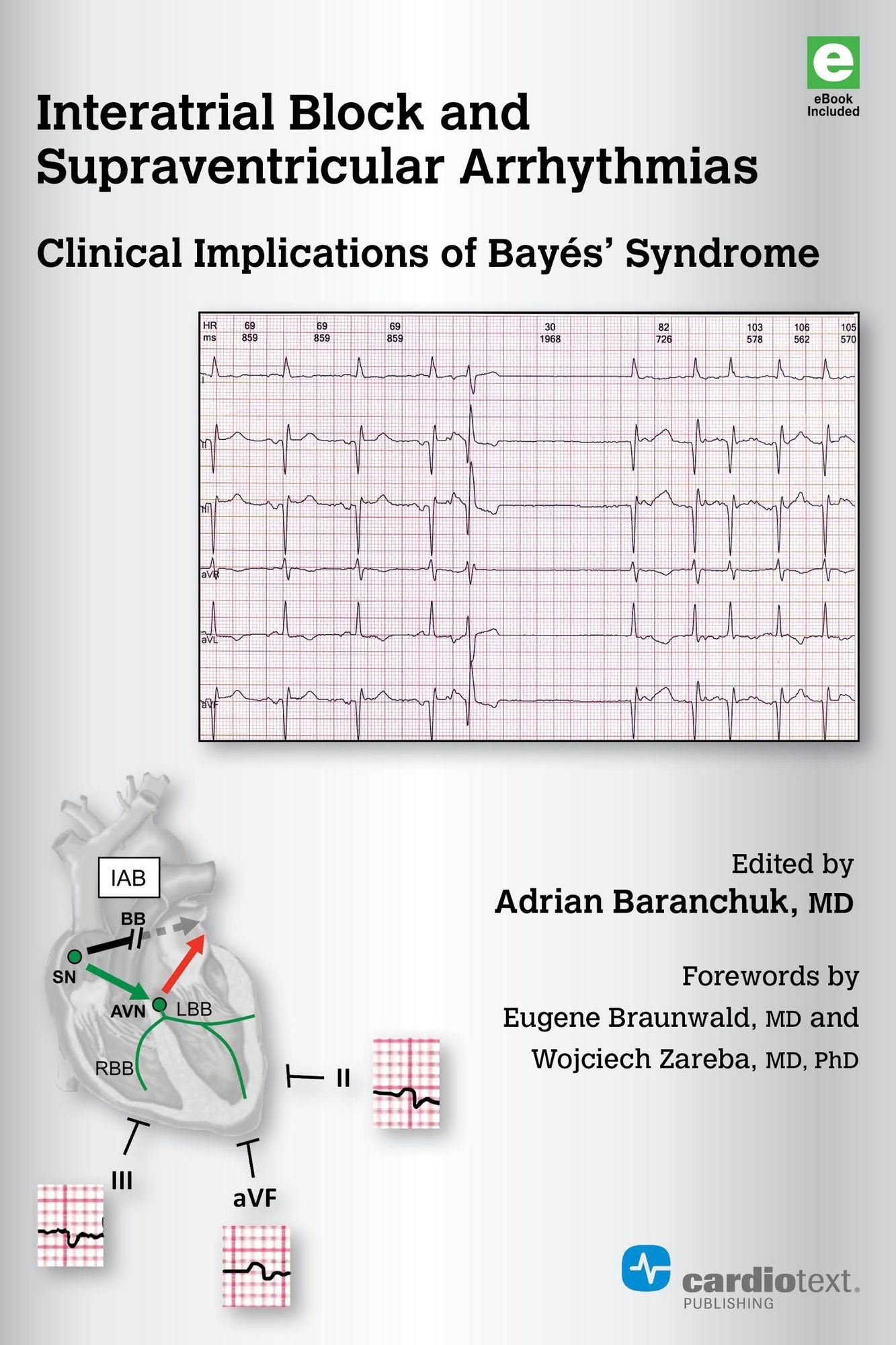 Interatrial Block and Supraventricular Arrhythmias: Clinical Implications of Bayés' Syndrome