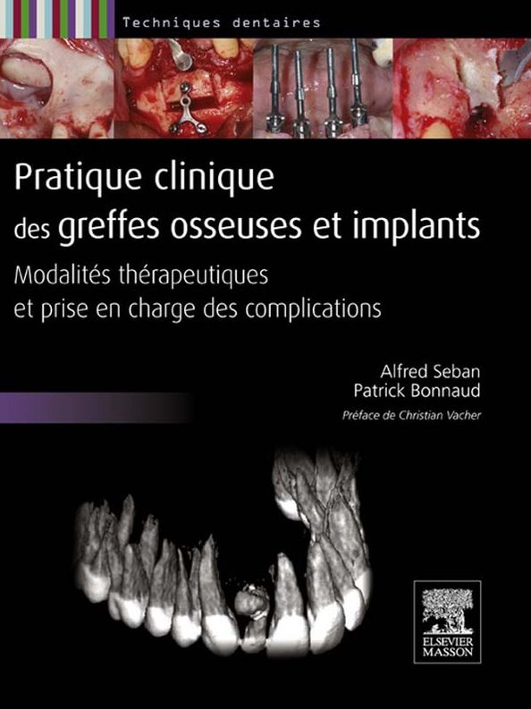 Pratique clinique des greffes osseuses et implants: Modalités thérapeutiques et prise en charge des complications