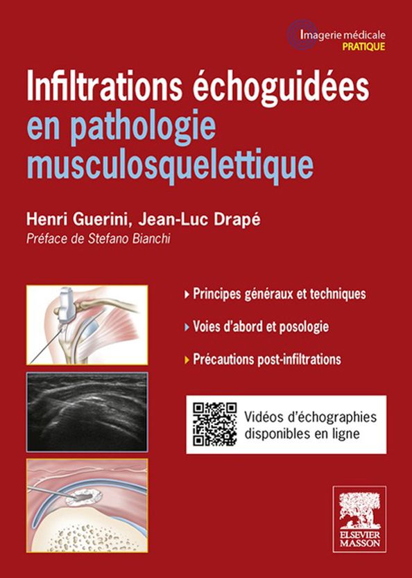 Infiltrations échoguidées