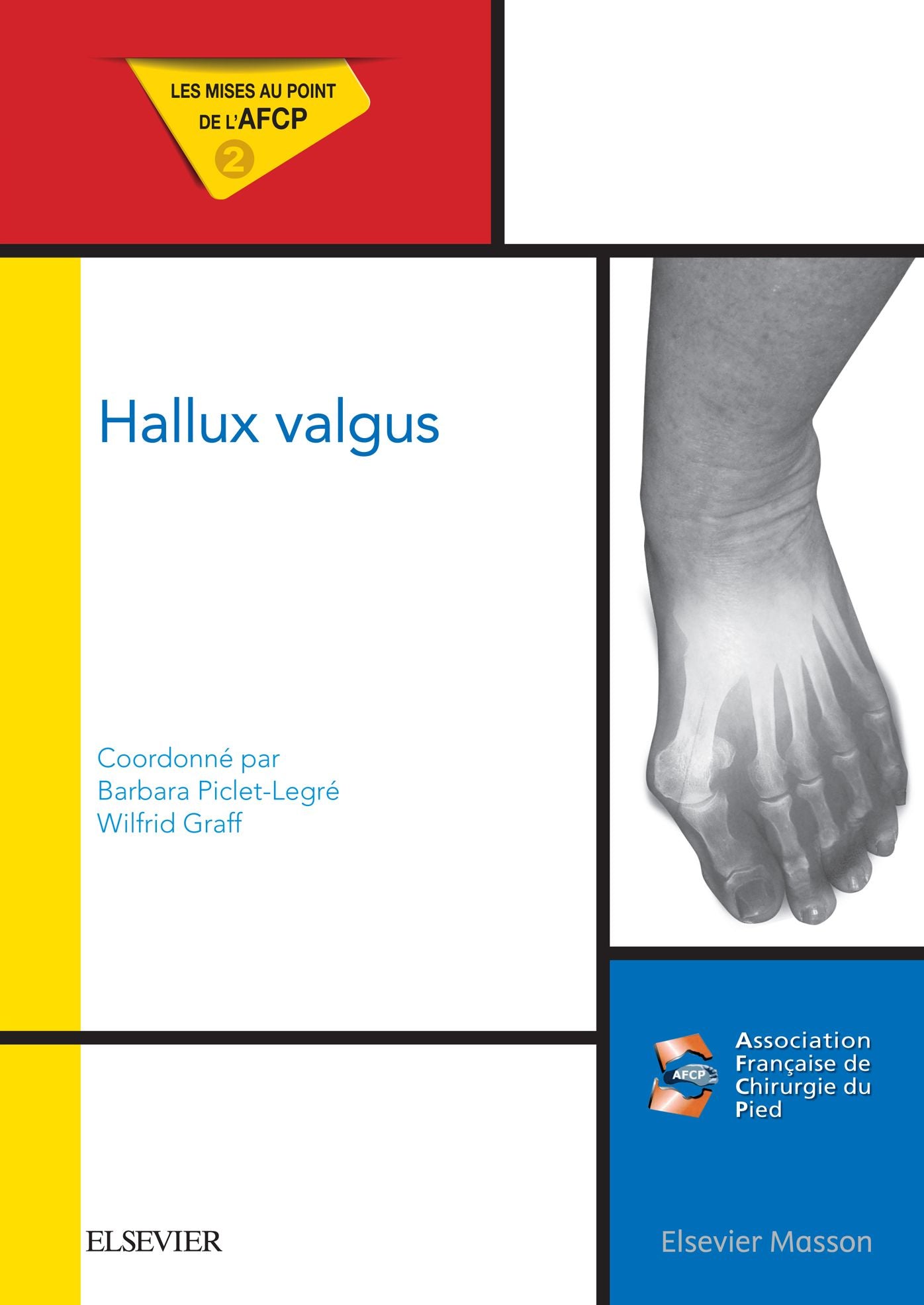 Hallux valgus: Mises au point de l'AFCP