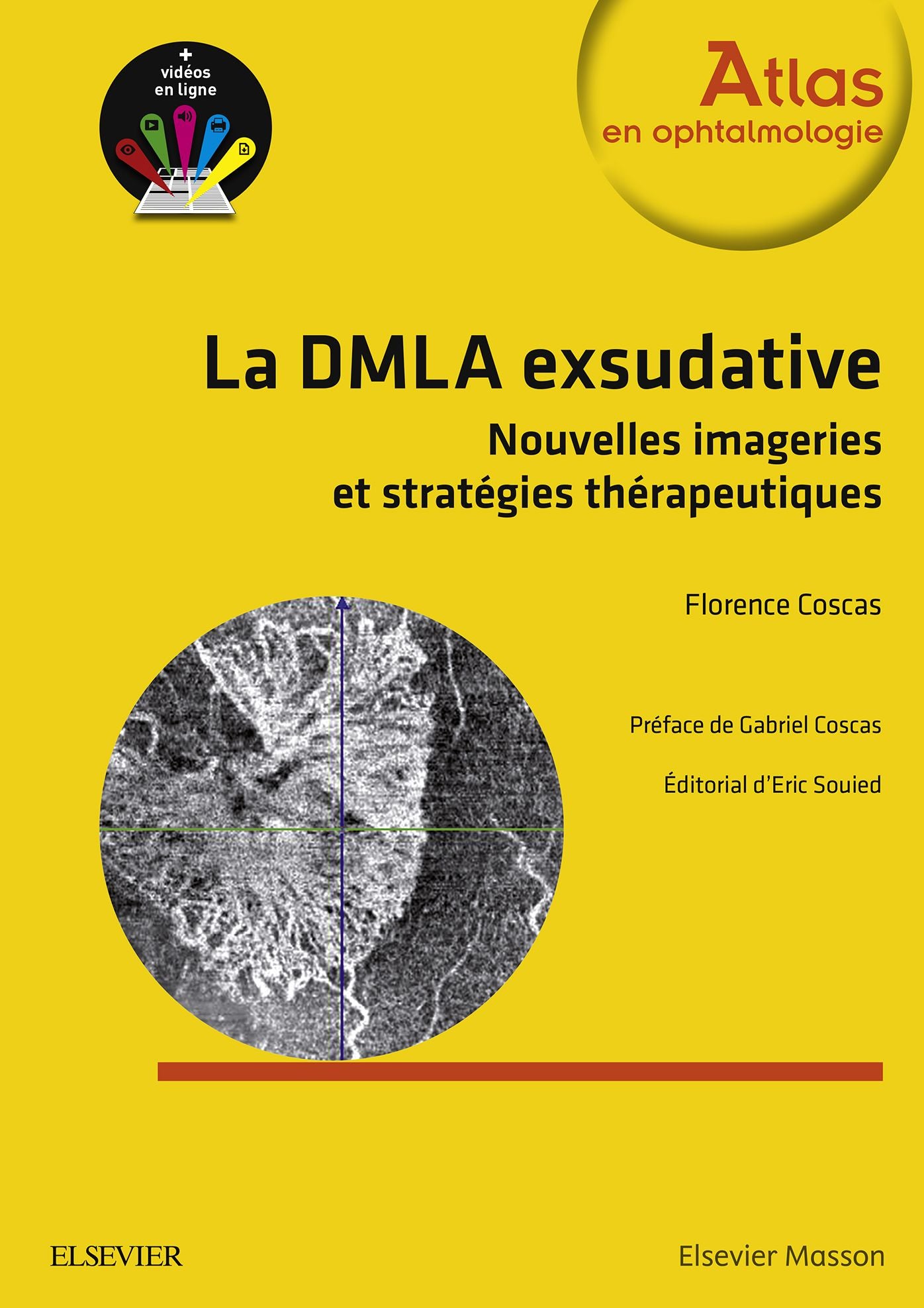 La DMLA exsudative: Nouvelles imageries et stratégies thérapeutiques