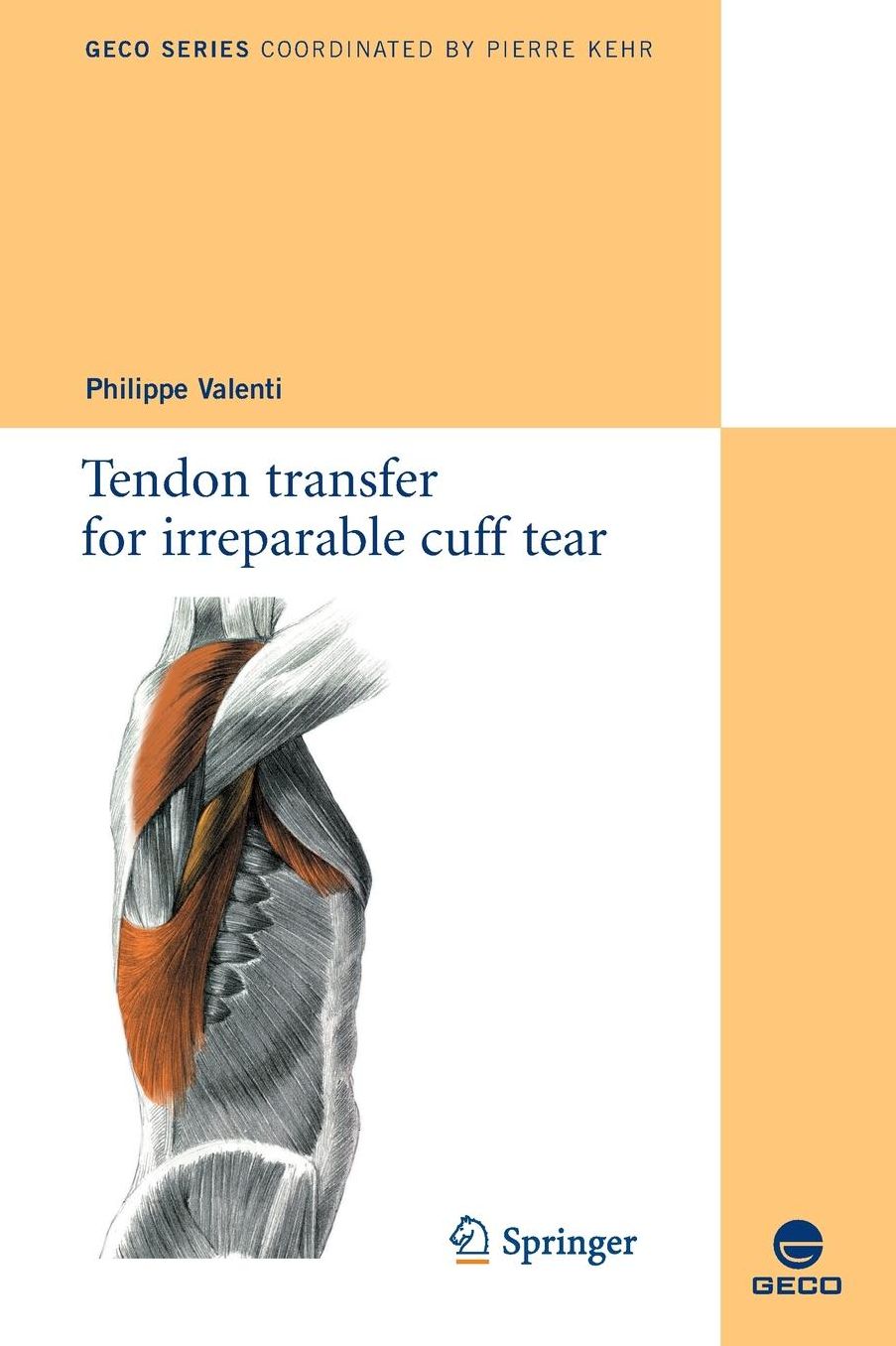 Tendon transfer for irreparable cuff tear