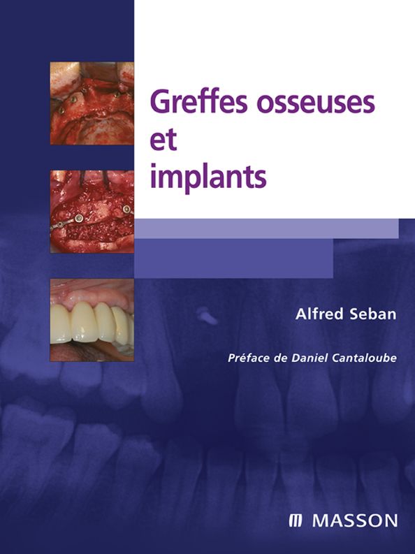 Greffes osseuses et implants