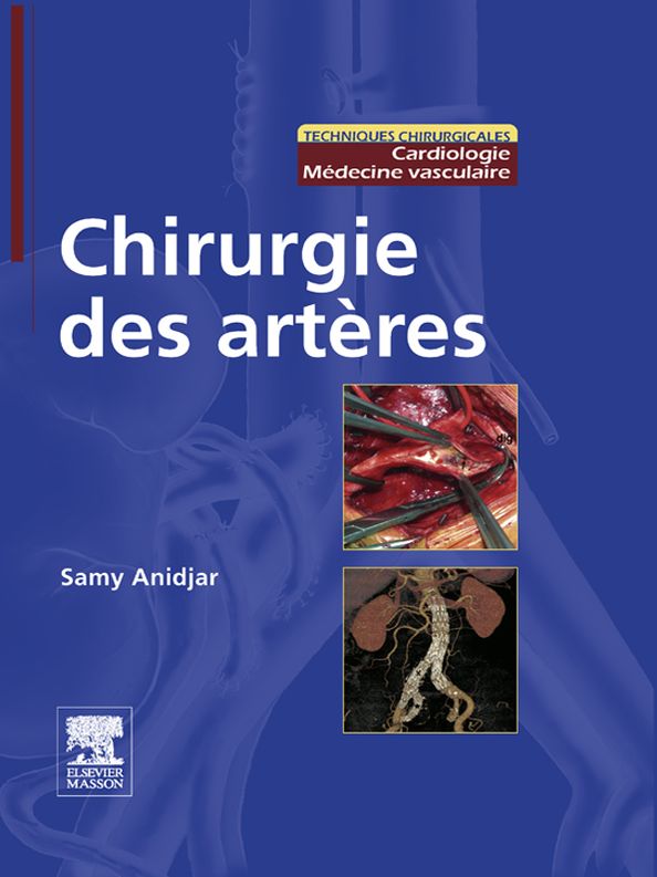 Chirurgie des artères