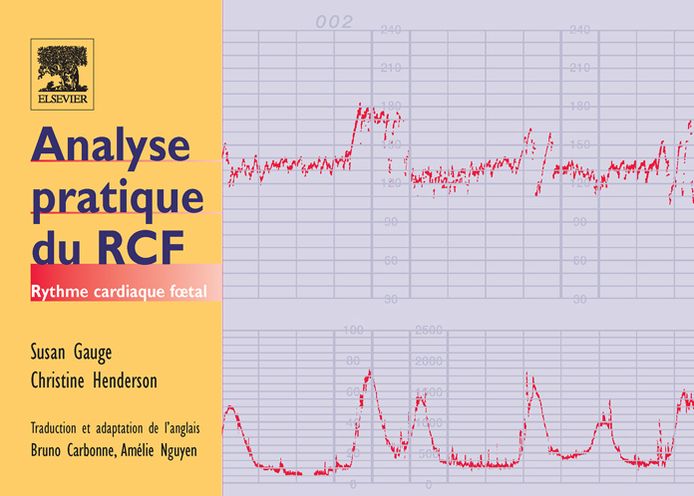 Analyse pratique du RCF: Rythme cardiaque foetal