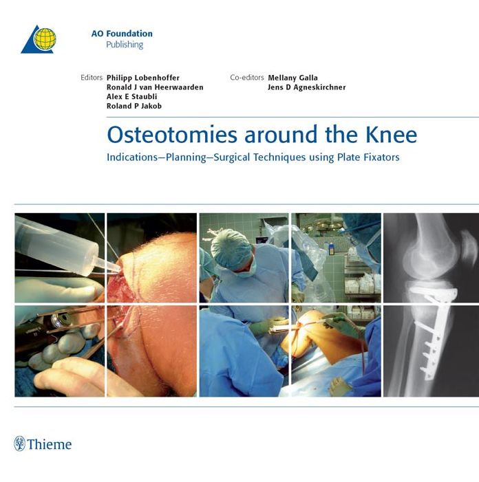 Osteotomies around the Knee: Indications-Planning-Surgical Techniques using Plate Fixators