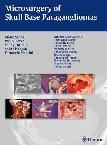 Microsurgery of Skull Base Paragangliomas