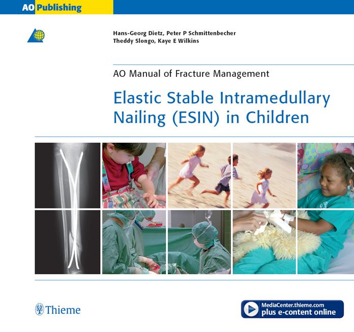 Elastic Stable Intramedullary Nailing (ESIN) in Children