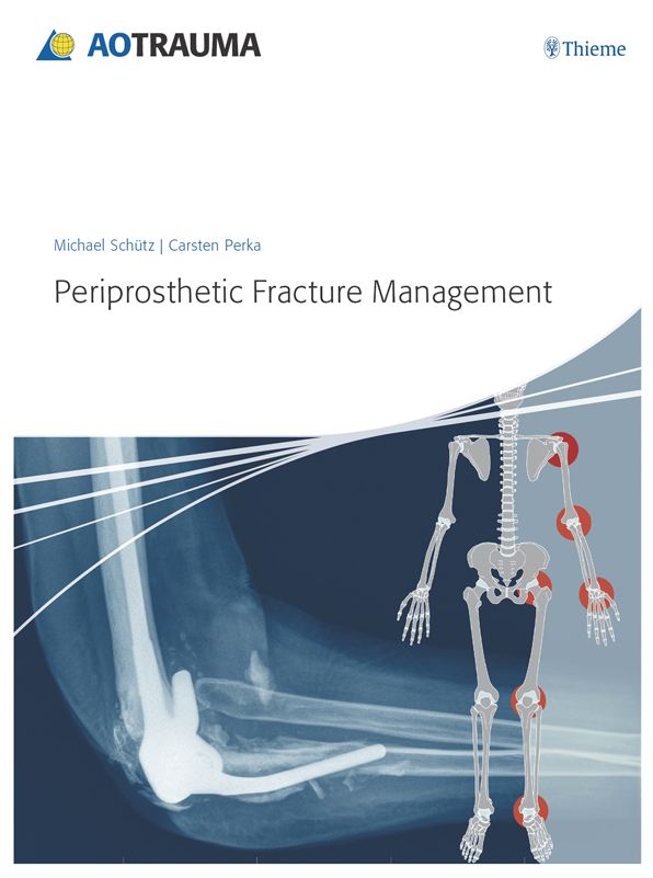 Periprosthetic Fracture Management
