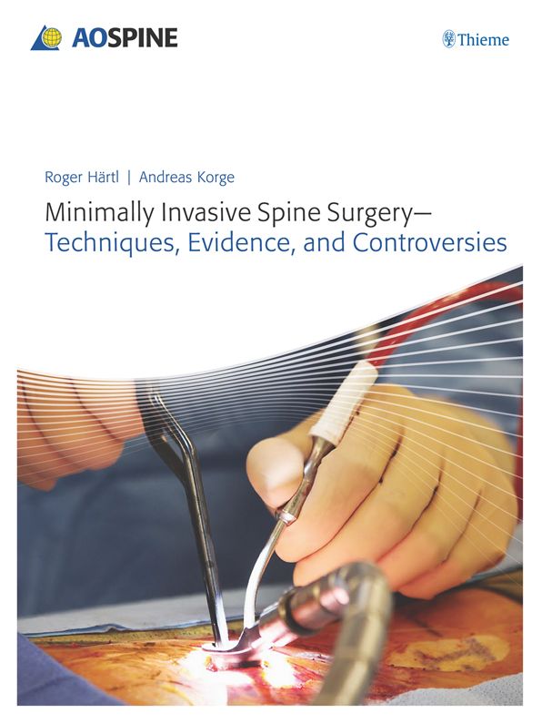 Minimally Invasive Spine Surgery: Techniques, Evidence, and Controversies