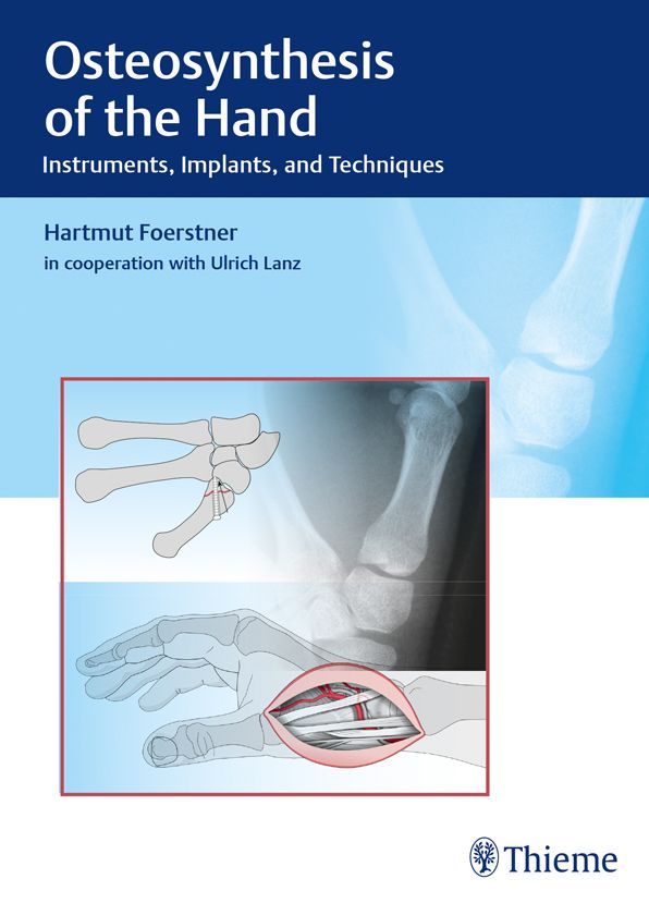 Osteosynthesis of the Hand: Instruments, Implants, and Techniques
