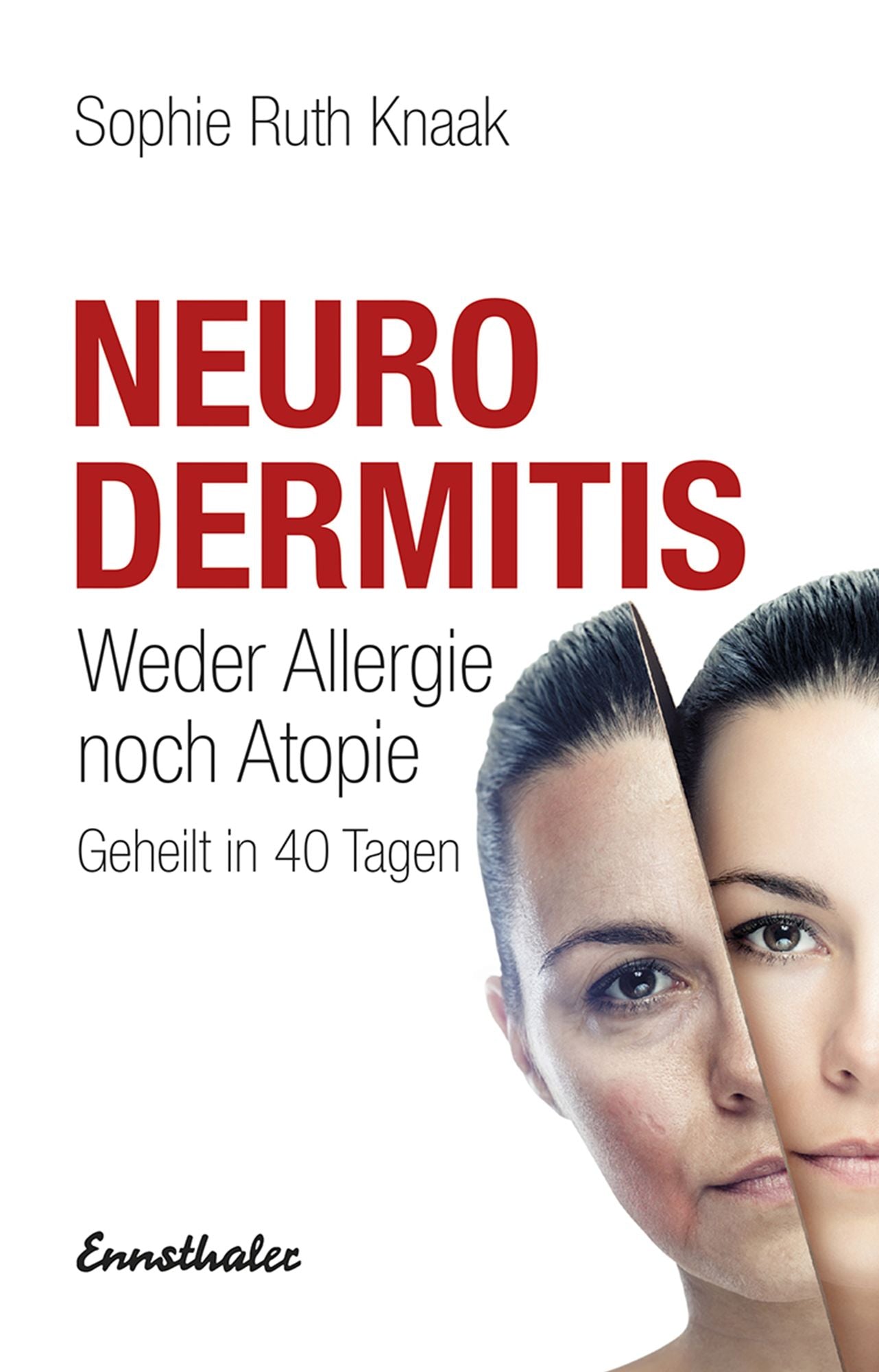 Neurodermitis: Weder Allergie noch Atopie - Geheilt in 40 Tagen