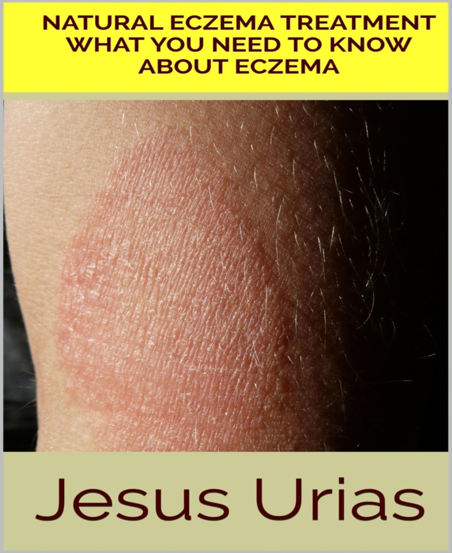 Natural Eczema Treatment: What You Need to Know About Eczema