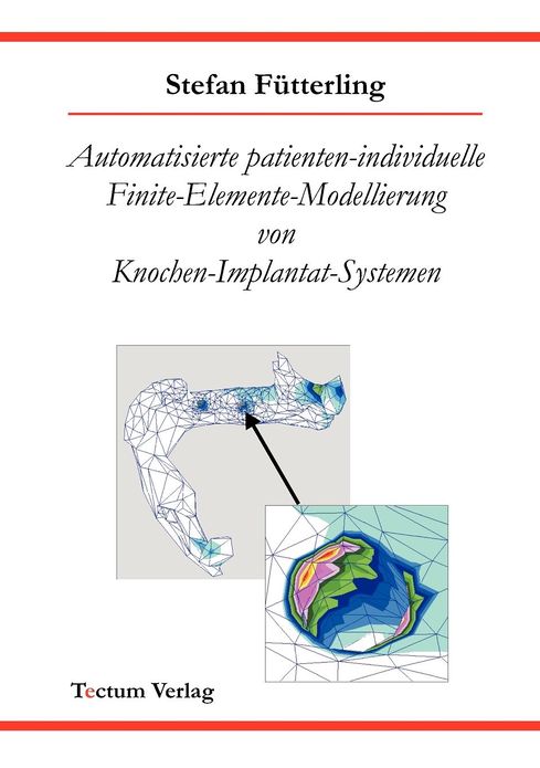 Automatisierte patienten-individuelle Finite-Elemente-Modellierung von Knochen-Implantat-Systemen