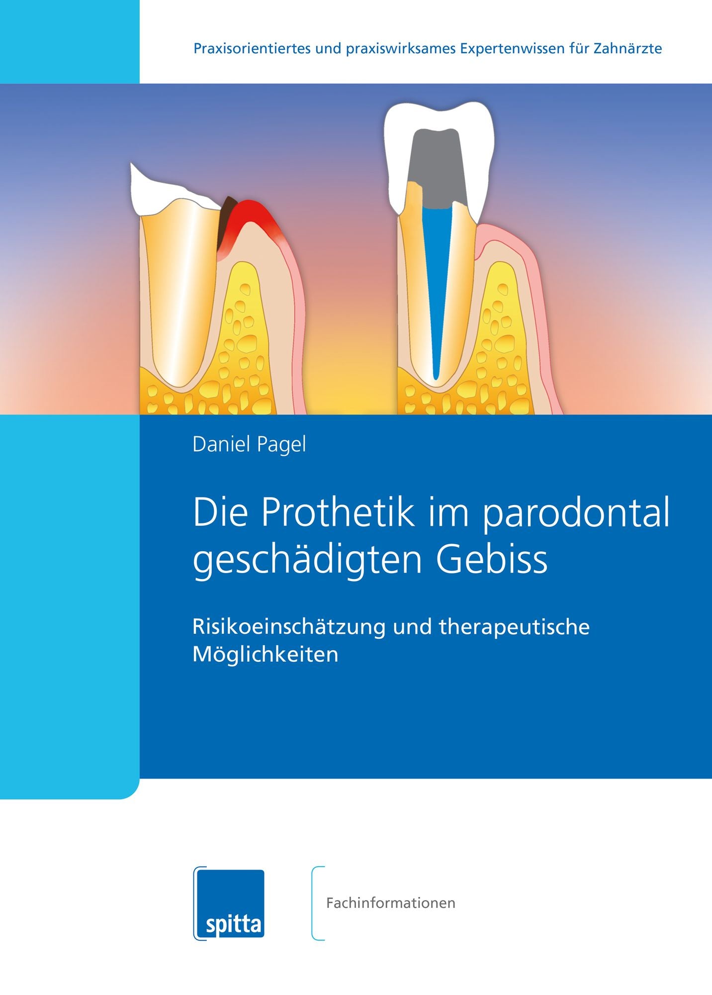 Die Prothetik im parodontal geschädigten Gebiss: Risikoeinschätzung und therapeutische Möglichkeiten