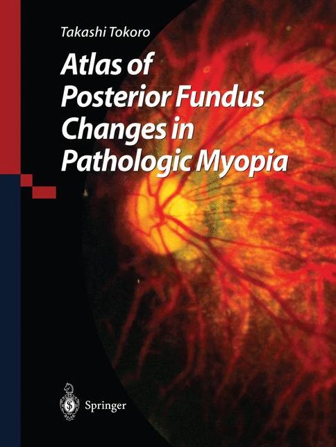 Atlas of Posterior Fundus Changes in Pathologic Myopia