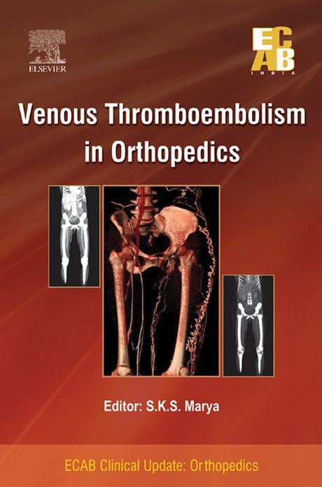 Venous Thromboembolism in Orthopedics - ECAB