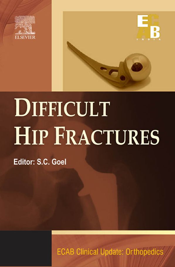 ECAB Difficult Hip Fracture - E-Book
