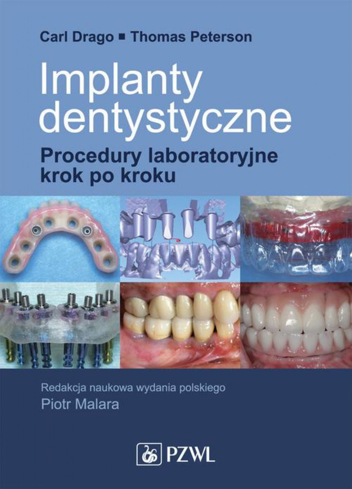 Implanty dentystyczne. Procedury laboratoryjne krok po kroku