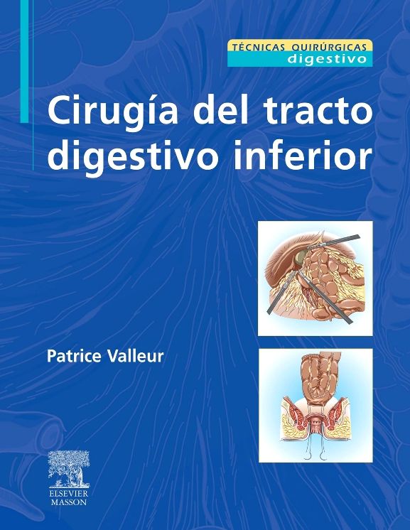 Cirugía del tracto digestivo inferior