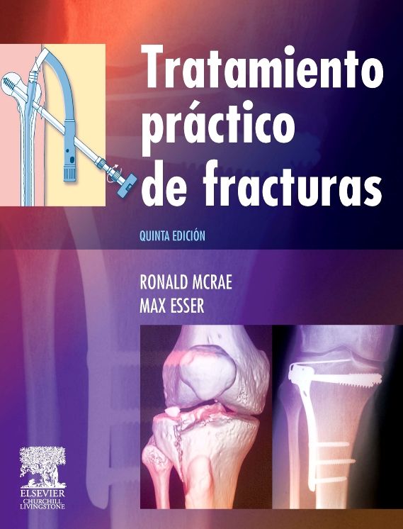 Tratamiento práctico de fracturas