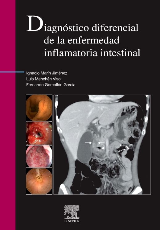 Diagnóstico diferencial de la enfermedad inflamatoria intestinal