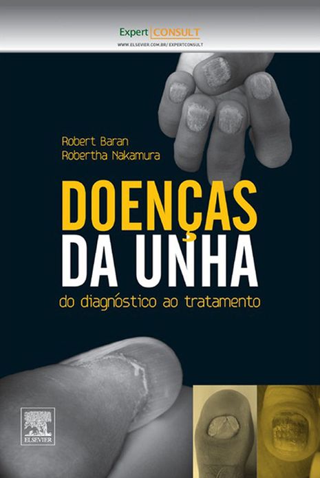 Doenças Da Unha: Do Diagnóstico ao Tratamento