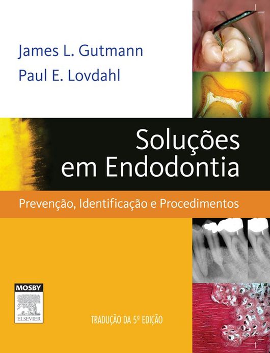 Soluções em Endodontia: Prevenção, Identificação e Procedimentos